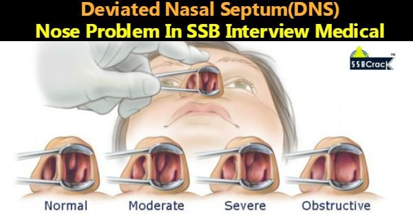 Deviated Nasal Septum(DNS) Nose Problem In SSB Interview Medical